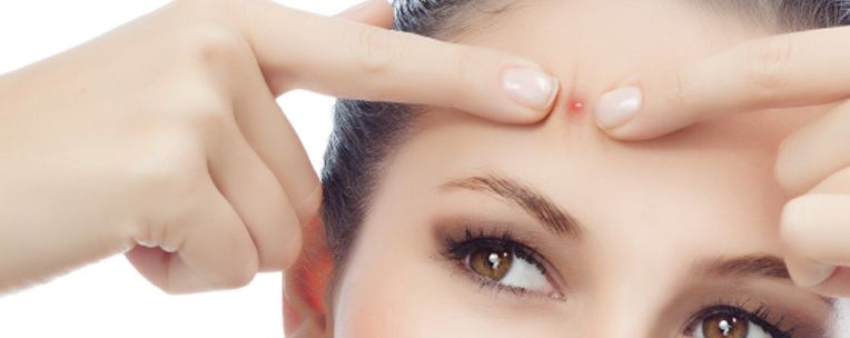Quick Fixes to Get Rid of Your Forehead Acne